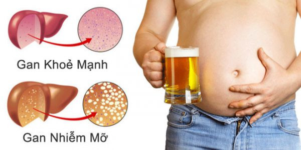 Gan Nhiễm Mỡ: Nguyên Nhân, Triệu Chứng và Cách Phòng Ngừa Hiệu Quả
